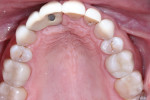 Figure 12 Post-treatment maxillary occlusal view.
