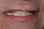 Figure 2 Maxillary anterior teeth showing the uneven alignment and discoloration of teeth Nos. 7 and 8.