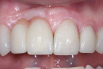 Figure 10 Close-up of the final anterior restorations, ovate pontic No. 7, and the use of pink porcelain to create the harmonious tooth size and length.