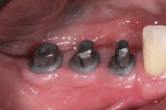 Figure 14 Clinical view of the CAD/CAM abutments inserted into the implants.