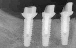 Figure 15 Radiograph confirming that the CAD/CAM abutments were fully seated.