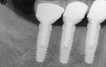 Figure 16 Radiograph confirming that the PFM crowns were fully seated.