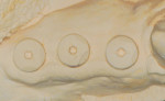 Figure 4 Stone model showing the coded healing abutments.