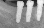 Figure 2 Radiograph of implants verifying that the coded healing abutments were fully seated.