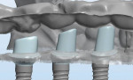 Figure 6 Virtual image of the proposed abutments with soft tissue and opposing dentition.