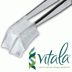 Vitala™ by Osteogenics Biomedical, Inc.