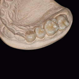 Full Contour Zirconia by One Source Dental Inc.