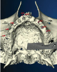 Figure 3  Views of the 3-D-rendered CT scan of the maxilla. The software is used to plan and display the position and direction of the implants.