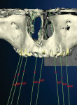 Figure 4  Views of the 3-D-rendered CT scan of the maxilla. The software is used to plan and display the position and direction of the implants.