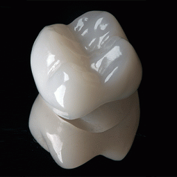 Porcelain-Fused-to-Metal Crowns by Danaren Dental Laboratory