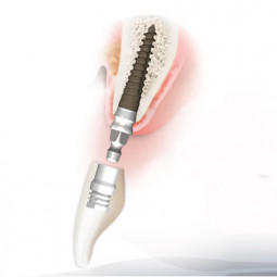 Lew MDI 3.0 mm Multi-Platform Implant by Park Dental Research