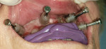 Figure 6  The surgical template in place in the mouth. Guided anchor pins (four) and the bite registration position and stabilize the surgical template.