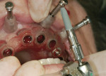Figure 7  The surgical template in place in the mouth. Guided anchor pins (four) and the bite registration position and stabilize the surgical template.