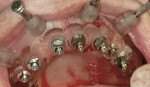 Figure 8  The surgical template in place in the mouth. Guided anchor pins (four) and the bite registration position and stabilize the surgical template.