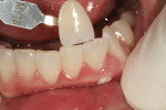 Figure 6 Selected shade is compared with surrounding dentition for accurate translucency.