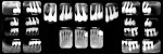 Figure 10  Final radiographs show good alignment of the implants and maximum use of the available osseous structure.
