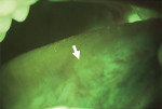 Figure 6 View of the lateral tongue with VELscope showing no dysplastic changes. Figure courtesy of the British Columbia Oral Cancer Prevention Program.