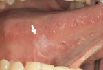 Figure 5 White lesion visible on the lateral tongue under white light. Figure courtesy of the British Columbia Oral Cancer Prevention Program.