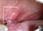 Figure 3 Area of dysplasia noted with the unaided eye.