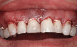 Figure 4 Retracted frontal view immediately after crown lengthening.