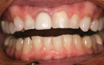 Figure 2 Preoperative retracted view of the patient's dentition.