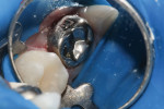 Figure 4 Crown can be seated and cemented before Biodentine is completely set.