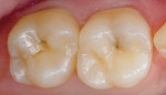 Figure 6  Preoperative view of occlusal caries in teeth Nos. 14 and 15.
