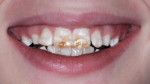 Figure 1 An 11-year-old patient with dark brown staining from fluorosis experienced persistent teasing because of his appearance. Case photo courtesy of Dr. Len Tau.
