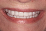 Figure 6 The intraoral mock-up altering incisal lengths that received patient approval.