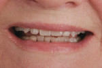 Figure 2 1:2 frontal smile