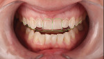 Figure 12 Central width-to-height ratio was 97% and the patient had a concave smile. Some teeth were tipped lingually in the arch, creating a deflective smile.