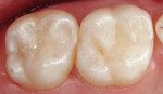 Figure 8  Postoperative view after restoration of the cavities with a nano-hybrid composite (Artiste, Pentron Clinical Technologies).