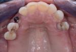 Figure 3 Preoperative occlusal view showing implant and edentulous posterior.
