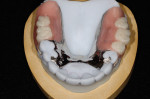 Figure 6 The removable partial denture on the stereolithography model.