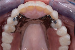 Figure 7 The removable partial denture seated in the mouth. Note the clear clasps that can be seen on teeth No. 4 and No. 12.