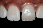 Figure 11  A dentin-shaded composite (Artiste A2 Dentin, Pentron Clinical Technologies) was used to reproduce the dentin.