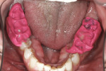 Figure 4 Correct interocclusal bite record, which is accurate because of the index and material selection.