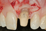 Figure 3  A new chamfer margin was prepared in the tooth 1 mm from the pre-existing margin.