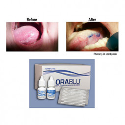 OraBlu Oral Lesion Marking System by AdDent, Inc.