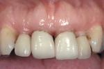Figure 2  A classic presentation of periodontal disease showing apical migration of all the papilla and open gingival embrasures.