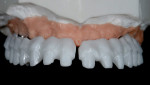 Figure 10 Zirconia frame prior to application
of stains.