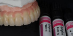 Figure 18 Dark Pink composite bonded to the darker gingiva areas.