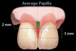 Figure 4  An average papilla with a 2-mm biologic width and 3-mm sulcus. The tip of the papilla extends 5 mm above the bone.