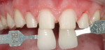 Figure 13 and Figure 14 This patient’s minimal tooth preparation led the technician to select an Opal 2. Clinical photography by Dr. J. Files.