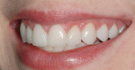 Figure 13 and Figure 14 This patient’s minimal tooth preparation led the technician to select an Opal 2. Clinical photography by Dr. J. Files.