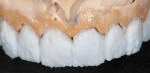 Figure 15 and Figure 16 For these layered restorations, modified core design (illustrated in Figure 17) provides control over the restoration value and optimum esthetics.