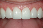 Figure 1 IPS e.max layered crowns for a patient requiring anterior restorations on teeth Nos. 5 to 12. The HT BL1 ingots were selected to improve the transparency as the teeth were not too dark and the required shade was OM1/OM2. Clinical photography by Dr. P. Timmins.