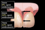 Figure 5  Tarnow’s findings on contact height above bone and open embrasures.
