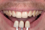 Figure 2 and Figure 3 These pictures clearly communicate the value of the patient’s teeth to the dental technicians fabricating the restoration.