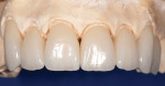 Figure 8 and Figure 9 Layered IPS e.max crowns for teeth Nos. 6 to 12. Clinical photography by Dr. H. Mizuta.